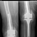 Frattura peri-protesica dopo prima revisione di protesi di ginocchio: revisione e osteosintesi. Successiva  rottura dell'impianto: ulteriore terza revisione revisione protesica e osteosintesi